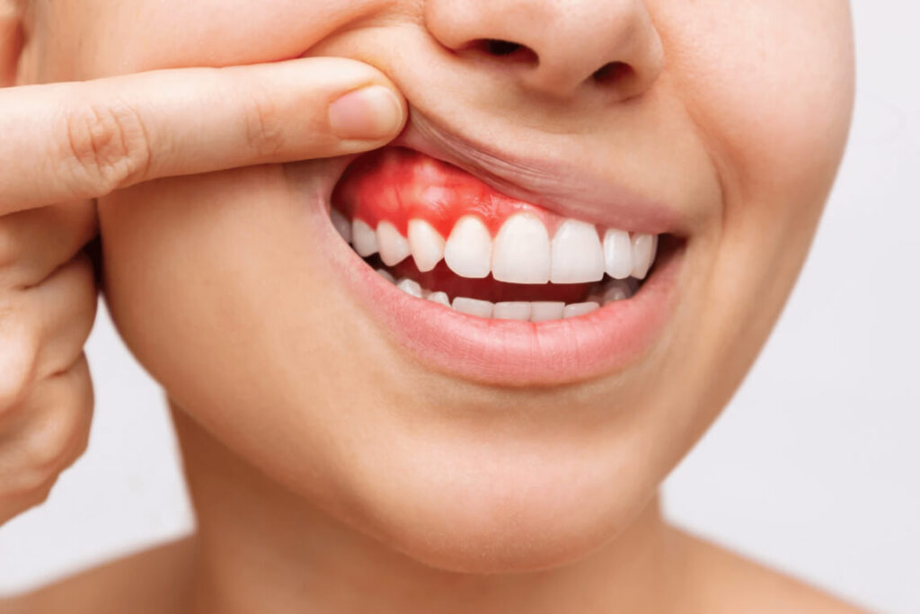 Periodontia Tratamento de Gengiva Sergipe