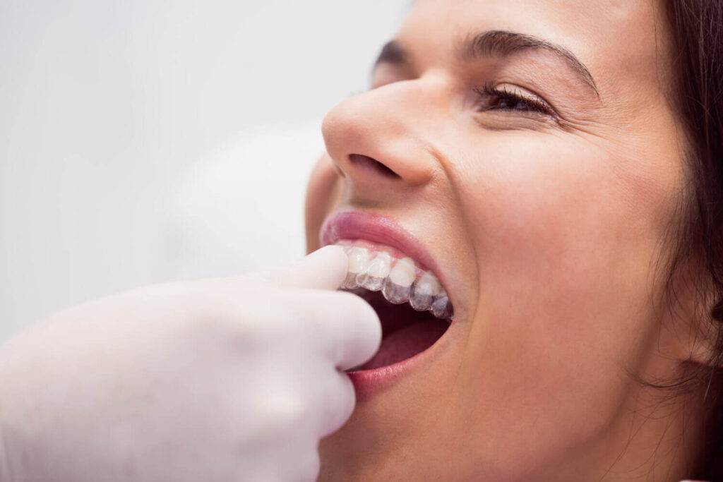 Aparelho Invisalign Vale a Pena em Sergipe?