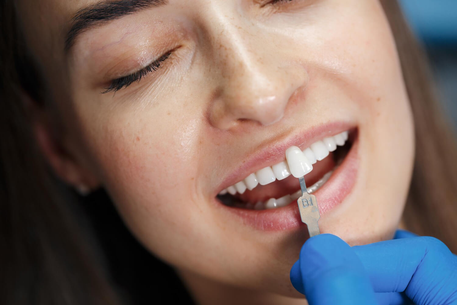 Close de dentista comparando escala de cor B1 com os dentes de uma paciente para aplicação de facetas de resina em Sergipe.